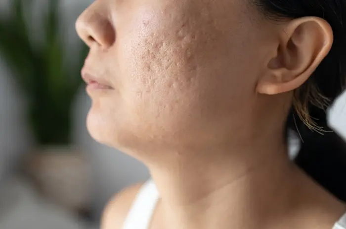 Acne Scars Are There Any Treatments Available